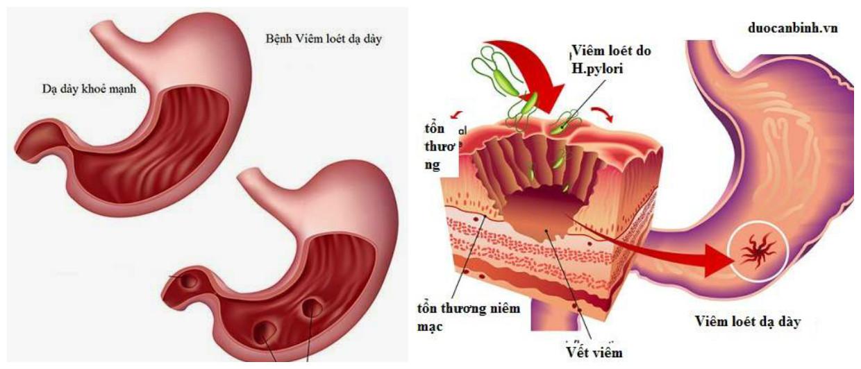 C:\Users\Hai\Desktop\triệu đức hòa\dạ dày\dạ dày bị tổn thương.jpg